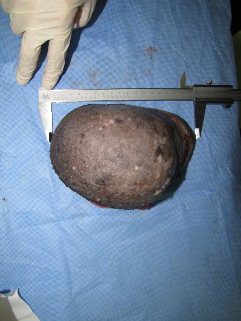 肛門周囲腫瘍