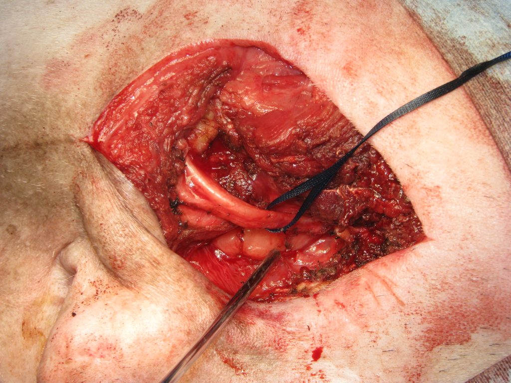 軟部組織肉腫